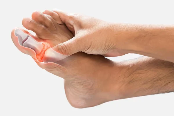 Gouty Arthritis